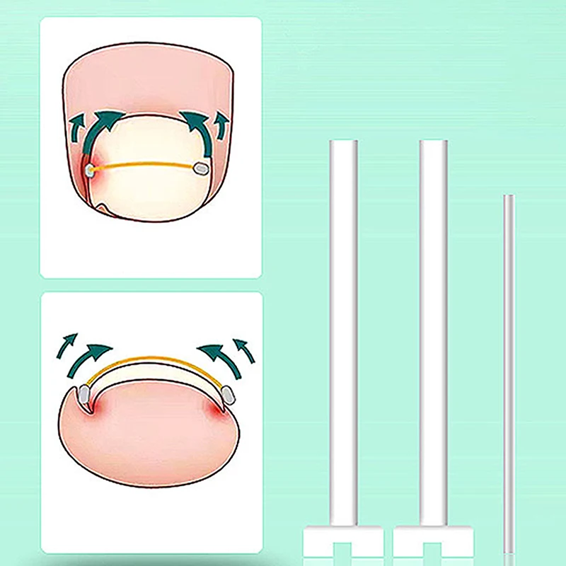Professional Ingrown Toenail Straightening Clip Brace Pedicure Tool Recover Embedded Toe Nail Corrector