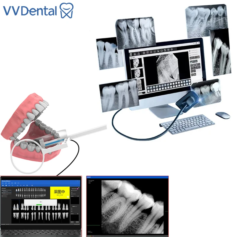 

VVDental Dental X-ray Sensor Radiovisiograph RVG Digital Sensor Intraoral Imaging System HD Image High-Frequency X Ray Dentistry