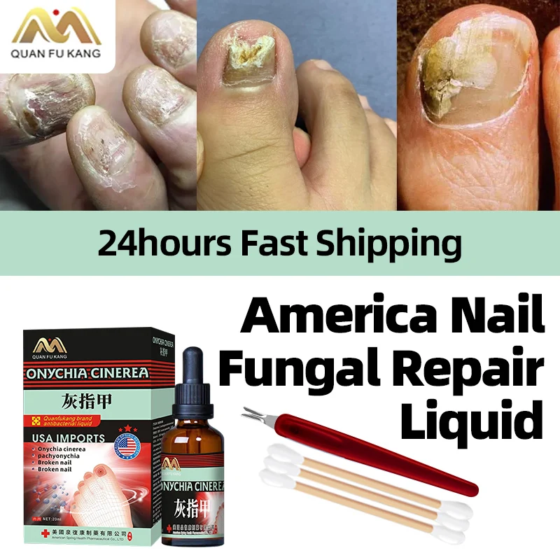 

Fungal Nail Treatment Liquid Paronychia Cleaner Nail Correction Onychomycosis Toe Fungus Medicine Foot Care American Formula