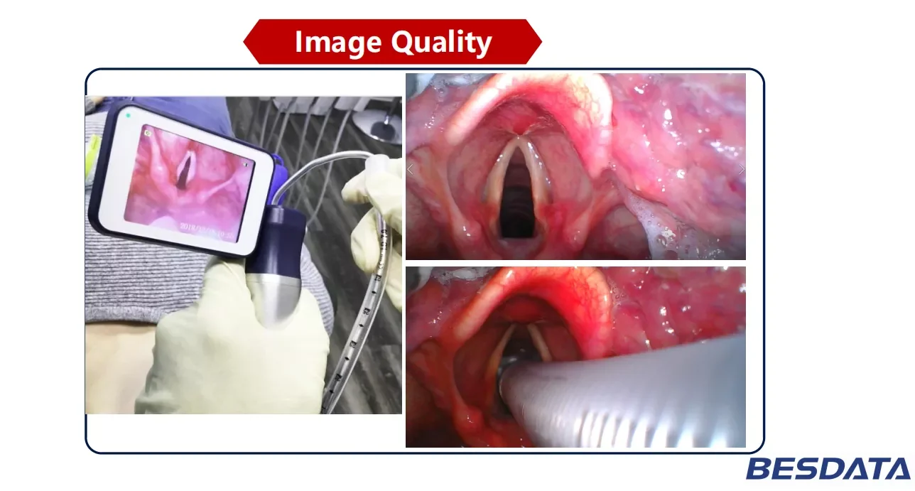 BESDATA portable Reusable Video Laryngoscope with high pixel and resolution