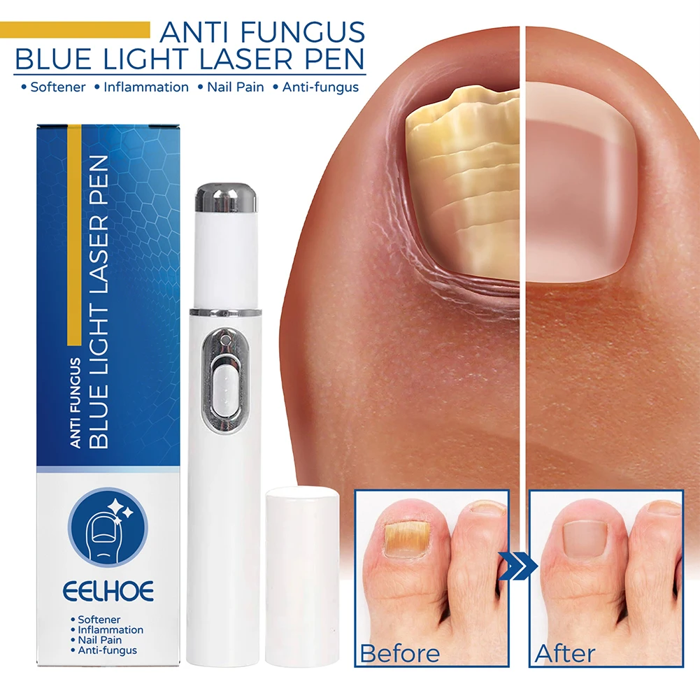 เชื้อราเล็บปากกาป้องกันเชื้อรา Paronychia เล็บซ่อมปากกา Onychomycosis ไม่เจ็บปวดแบบพกพากําจัดเซรั่มเจลเล็บเครื่องมือ