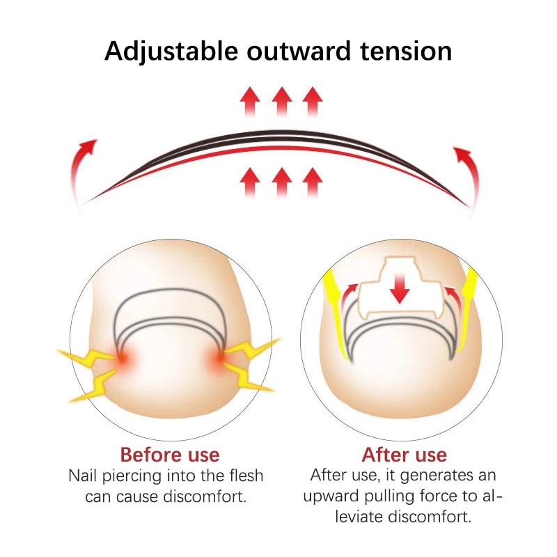 مجموعة دعامة تصحيح أظافر القدم ، عناية احترافية بالأظافر لأصابع القدم ، مثبت باديكير ومانيكير ، أداة استرداد