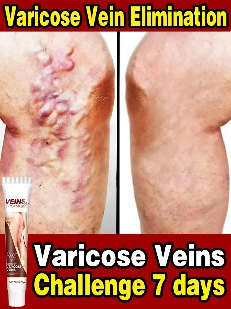 Varicose Vein Relief Paste Improve Blood Circulations Spider Varicose Vein For Tired Heavy Legs Fast Relief New