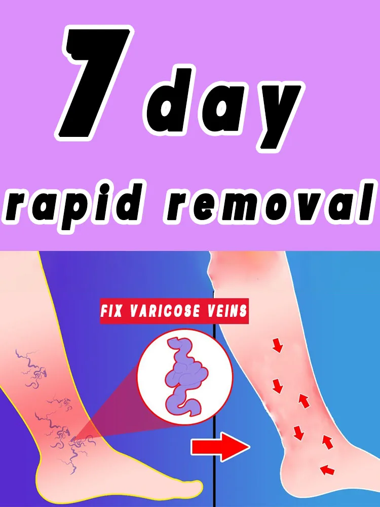 

Say goodbye to varicose veins and spider legs in 7 days