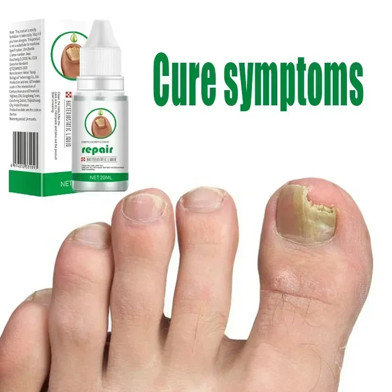 

Nail Repair Essence Fungal Nail Treatment Removal Onychomycosis Toe Nail Nourishing Hand and Foot Care