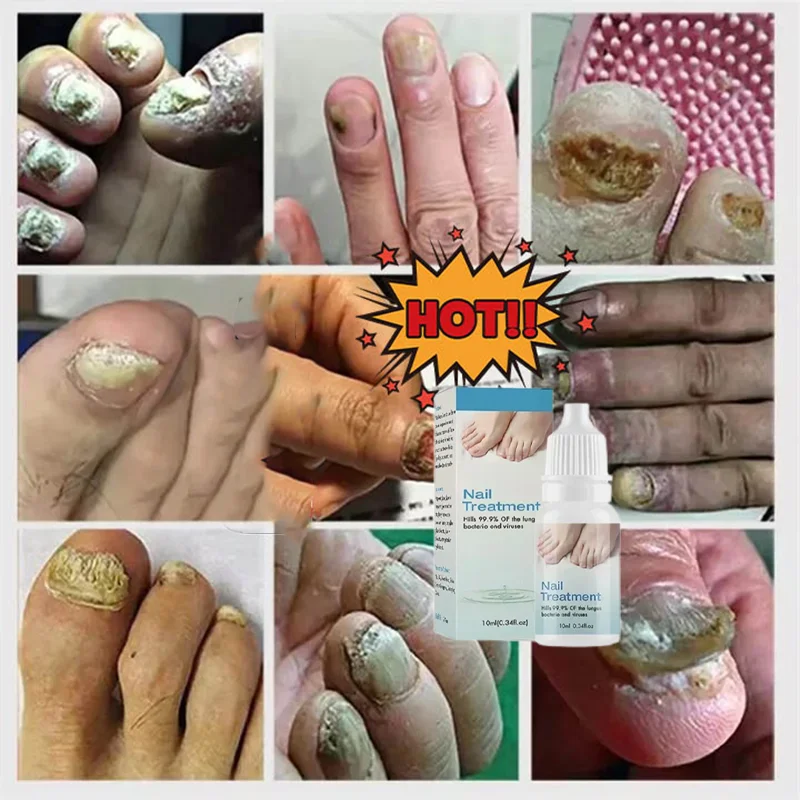 10ml Onychomycosis Reparatie Serumzalf Onychomycosis Paronychia Zorgcrème Nagel Teennagel Voetverzorging Reparatie Essence