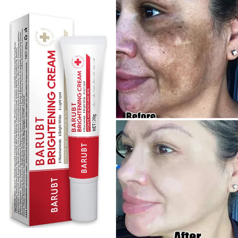 

Whitening Freckle Cream Melasma Dark Spots Pigmentation Removal Products Fade Stain Melanin Repair Brighten Korean Skin Care