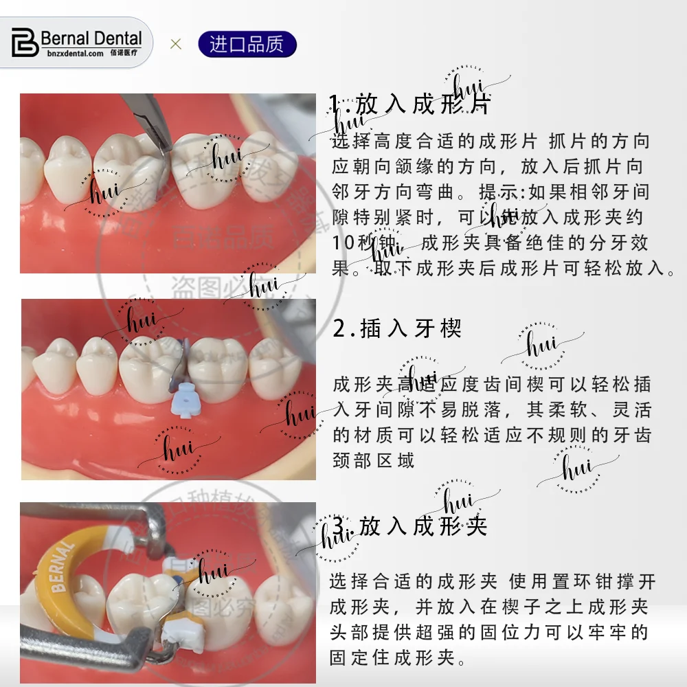 For SE-U061 BERNAL SECTIONAL MATRIX SYSTEM SET / Dentals Material