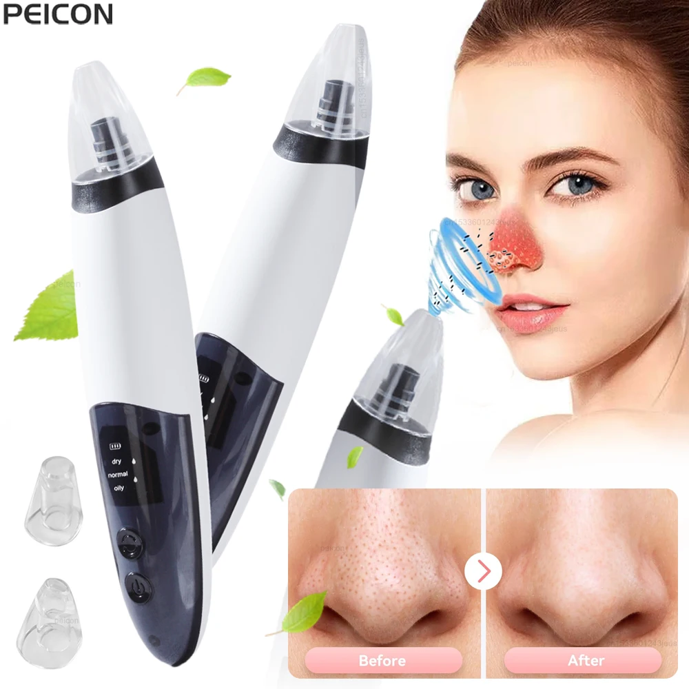 黒ずみ除去毛穴吸引器 顔の黒ずみ除去機 黒ずみ吸引器 電動ニキビ除去器 黒ずみ除去機
