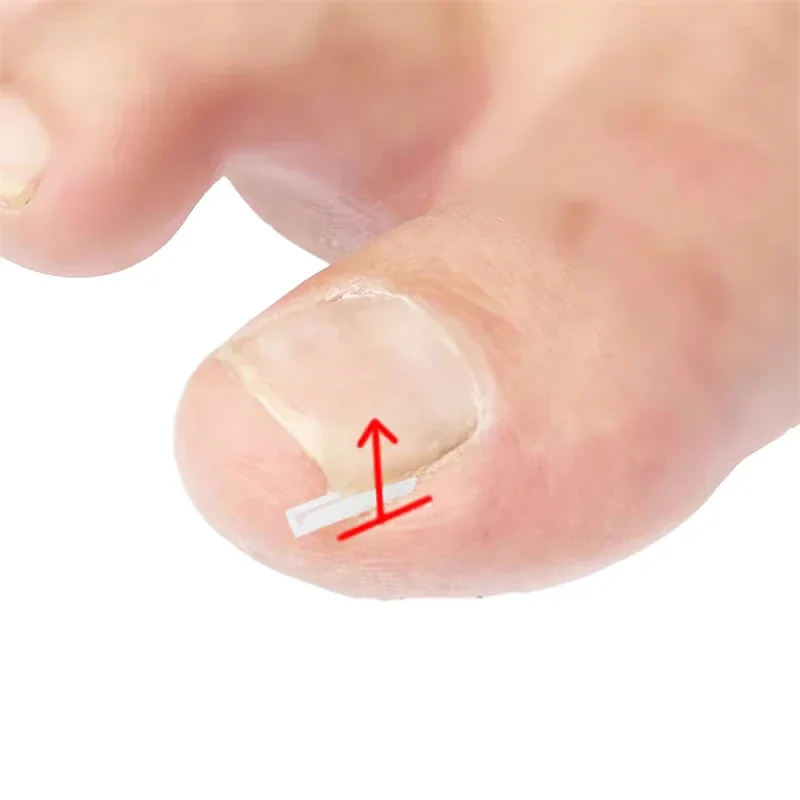 50 قطعة التصحيح المرن ملصق باديكير أداة نام أظافر تصحيح أداة نام تو مسمار العلاج استقامة كليب هدفين