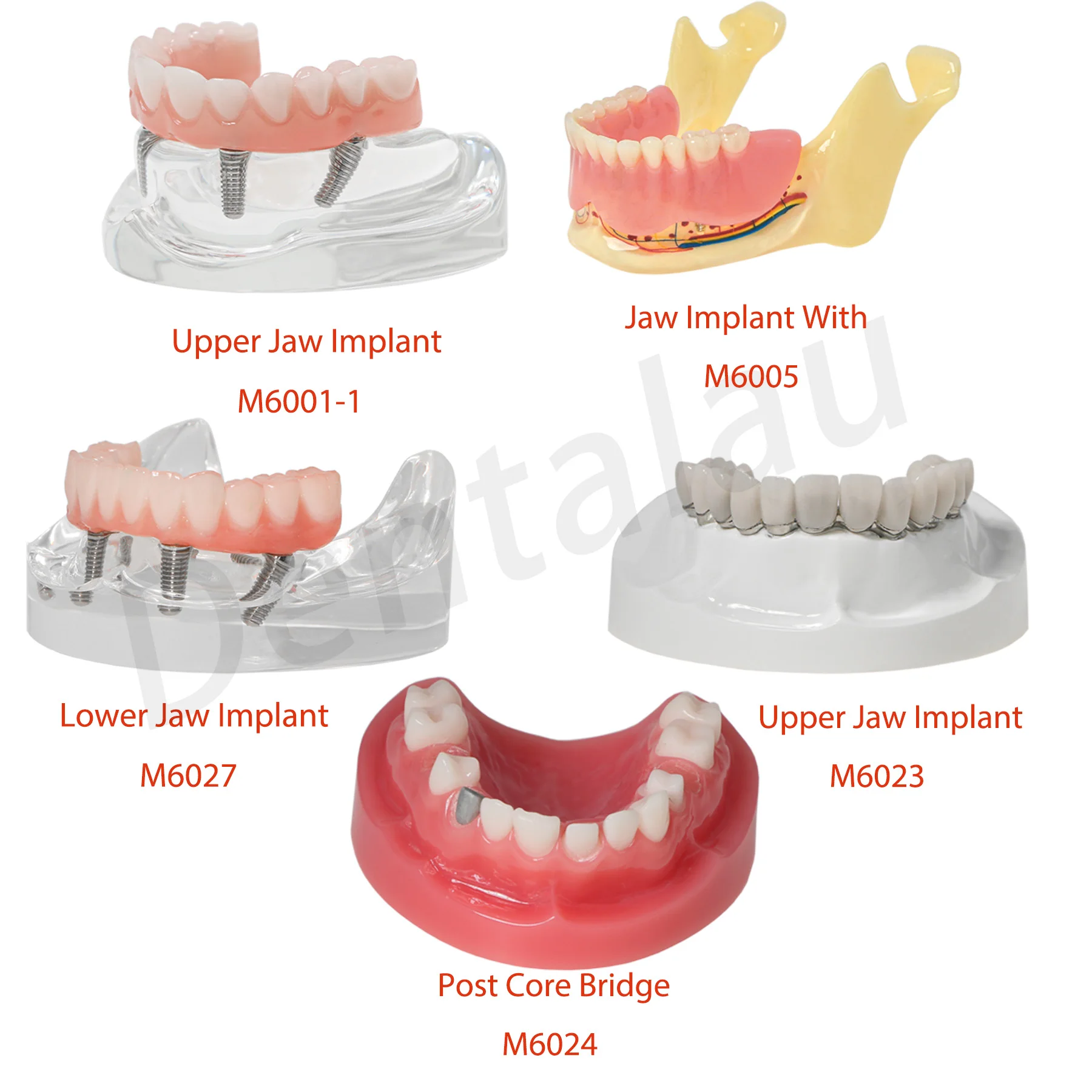 

Dental Implant and Restoration Typodont Teeth Models Jaw with Overdenture Series