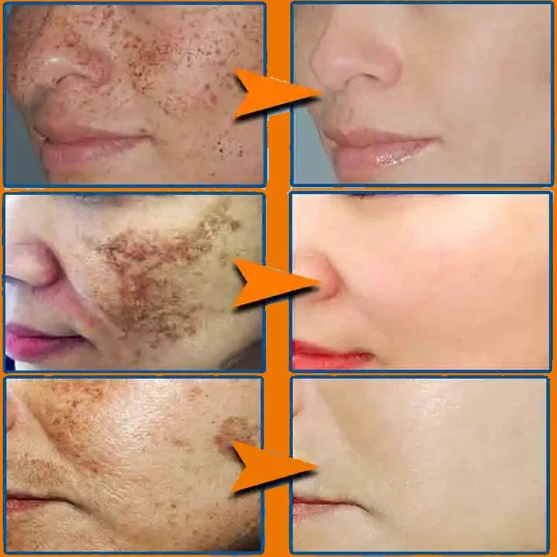 Effective Whitening Freckles Face Cream Remove Melasma Dark Spots Fade Melanin Acne Scars Anti-aging Brighten Repair Skin Care