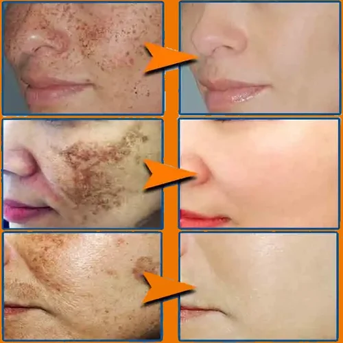 Imagen 2 del producto Crema facial blanqueadora efectiva para pecas, elimina el melasma, manchas oscuras, desvanece la melanina, cicatrices de acné, antienvejecimiento, ilumina, repara el cuidado de la piel