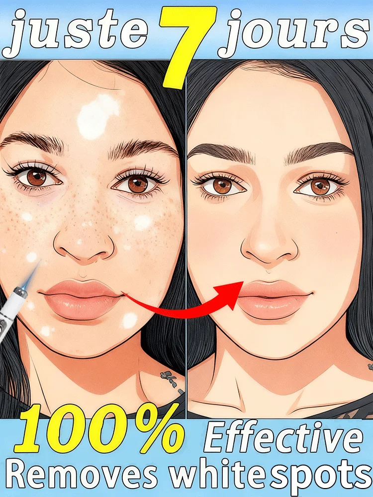 Generation-2 قلم الضوء الأزرق يقول وداعاً لجميع البهاق خلال 7 أيام