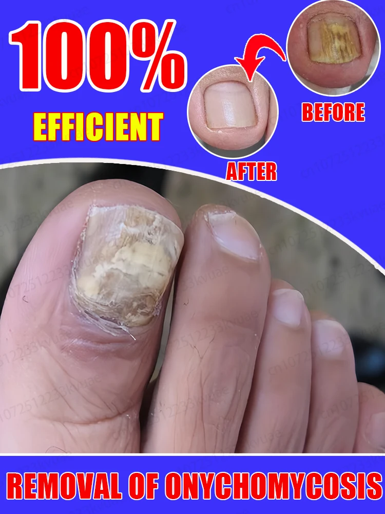 

Iɴsᴛᴀɴᴛ Eғғᴇᴄᴛ! Fᴜɴɢᴀʟ Nᴀɪʟ Essᴇɴᴛɪᴀʟ Oɪʟ, Tᴀʀɢᴇᴛɪɴɢ ᴛʜᴇ Rᴏᴏᴛ ᴏғ Fᴜɴɢᴜs,