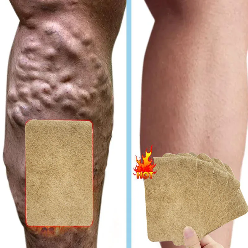 

8pcs/bag ZB Varicose Veins Plaster Vasculitis Phlebitis Spider Leg Medical Patches Angiitis Removal Chinese Herbal Patch