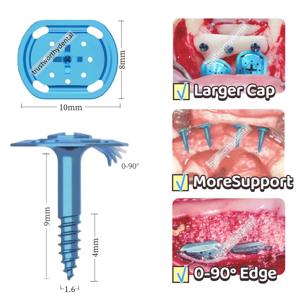 

Стоматологический GBR-винт для формирования костной опоры с широкой головкой, полурезьбовой, для восстановления костной ткани, 10 мм