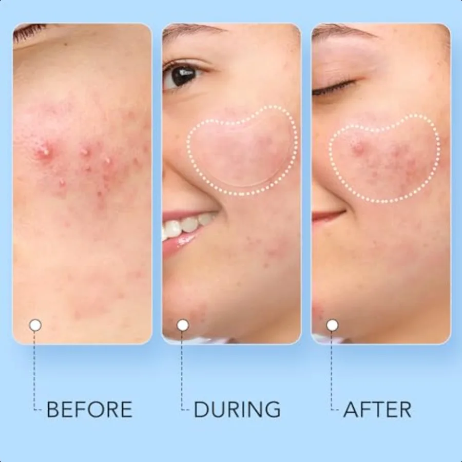 حب الشباب بثرة التصحيح 8 أحجام 140 قطعة بقع حب الشباب الغروانية المائية مع صندوق تخزين 24 XL بقع بثرة للوجه الذقن الأنف 4 أشكال Z #5