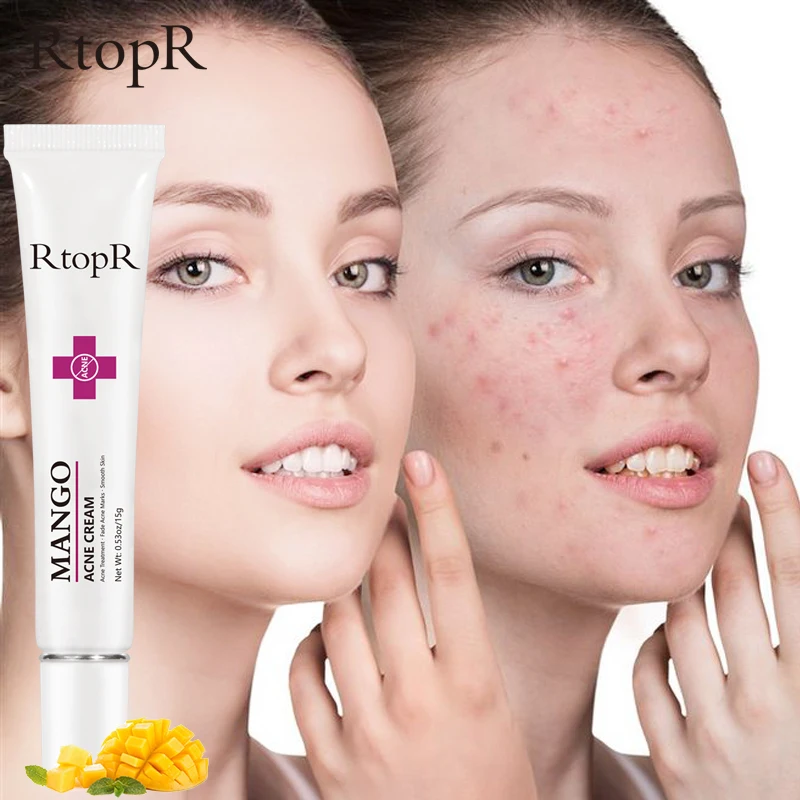 RtopR Acne Cream Mango Anti-acne oil control Face cream For Women And Man Repair Acne And Blackhead Spots Pore Shrinking Cream