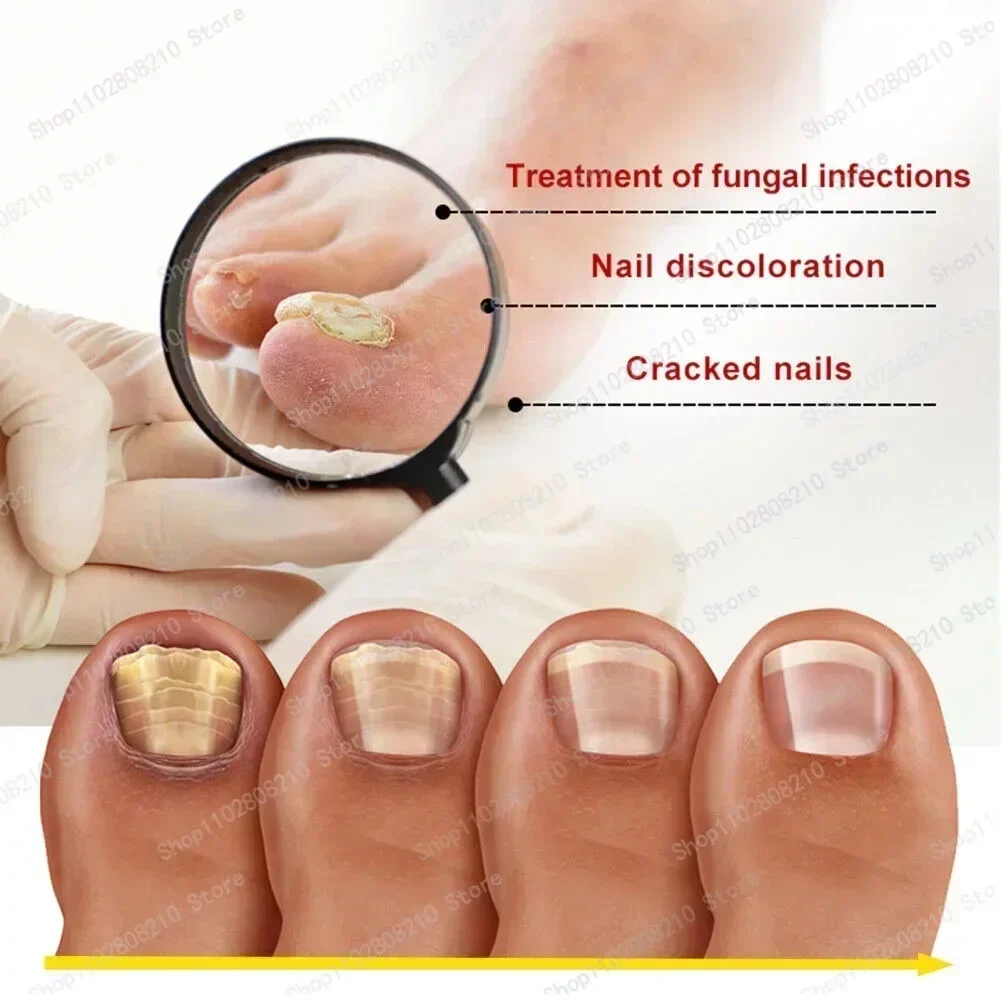 ขายร้อน Fungal NAIL Removal 10ML Fungal NAIL Foot Repair Essence เล็บเชื้อราเจลกําจัด Anti Infection