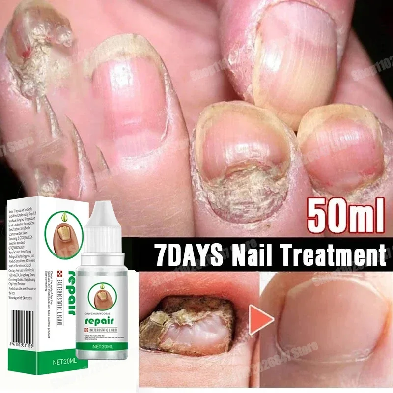 Nail Fungals Renewal Nail Repair Liquid for Discolored Thickened Crumbled Nails Nail Fungals for Discolored Broken Cracked 77