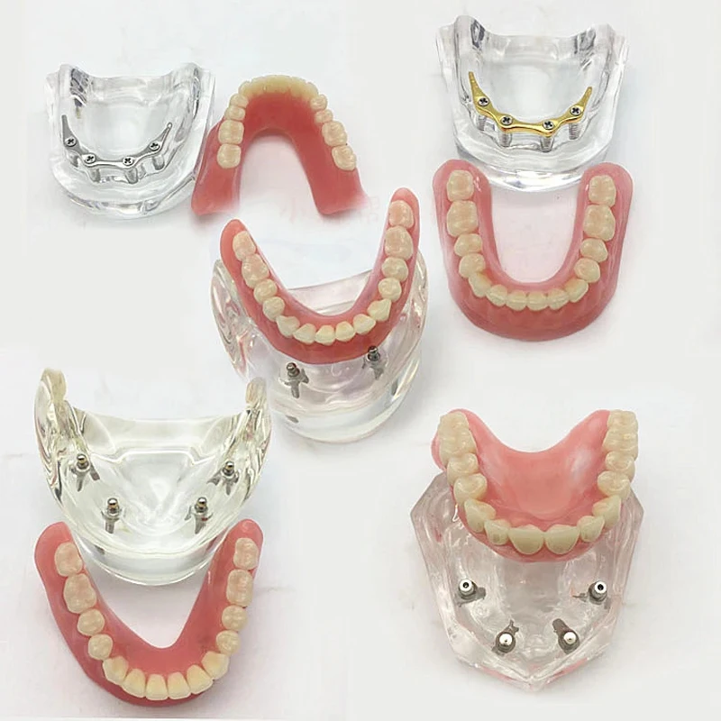 Dental Lower Tooth Implant Model Removable Interior Mandibular Demo Overdenture For Dentist Student Education Typodont Implant