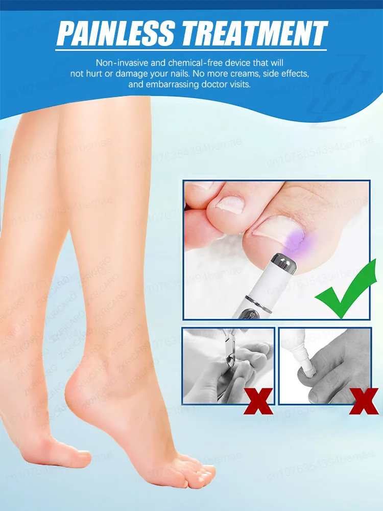 Prevent onychomycosis from getting worse and ᵖʳᵒᵗᵉᶜᵗ ᵗʰᵉ ʰᵉᵃˡᵗʰʸ ᵉⁿᵛⁱʳᵒⁿᵐᵉⁿᵗ ᵒᶠ ᵗʰᵉ ᶠᵉᵉᵗ