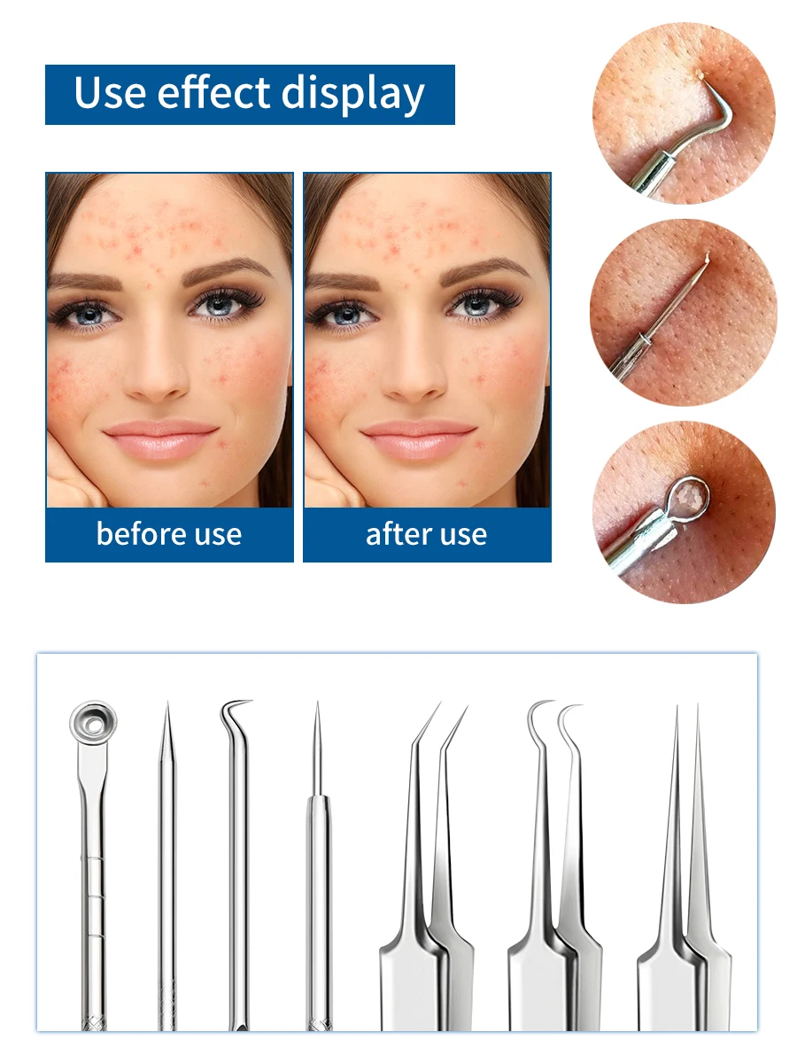 مجموعة إزالة الرؤوس السوداء مكونة من 7 قطع من إبرة حب الشباب، مستخرج حب الشباب، مجموعة تنظيف حب الشباب من الفولاذ المقاوم للصدأ المتين لكل من الرجال والنساء #6