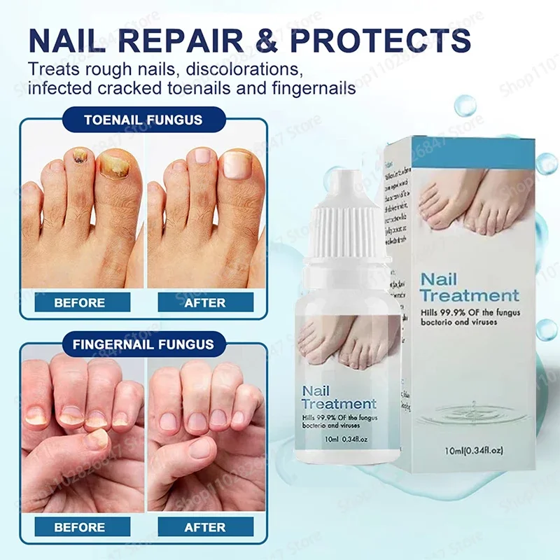 Anti Infection Cream Fungal Nail Removal Fungal Nail Treatment Oil Foot Repair Essence Toe Nail Fungus Removal Gel