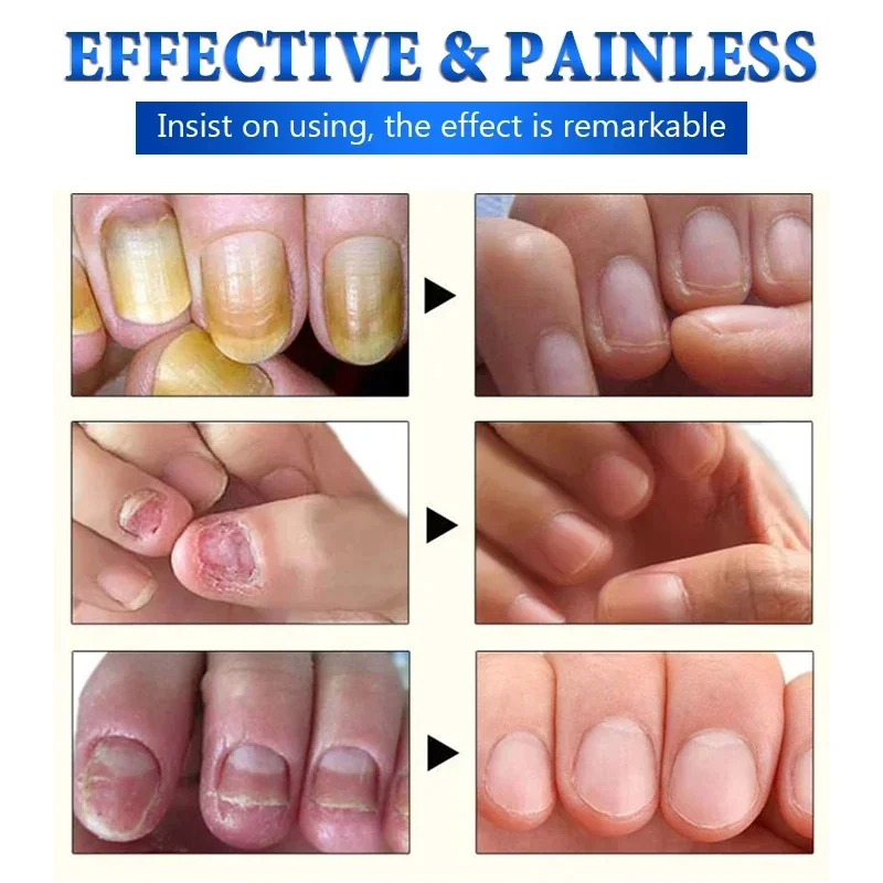 Tratamento de fungos nas unhas, soro para remoção de fungos nas unhas dos pés, gel de reparo, anti-infecção, paroníquia, onicomicose, essência para cuidados com as unhas dos pés