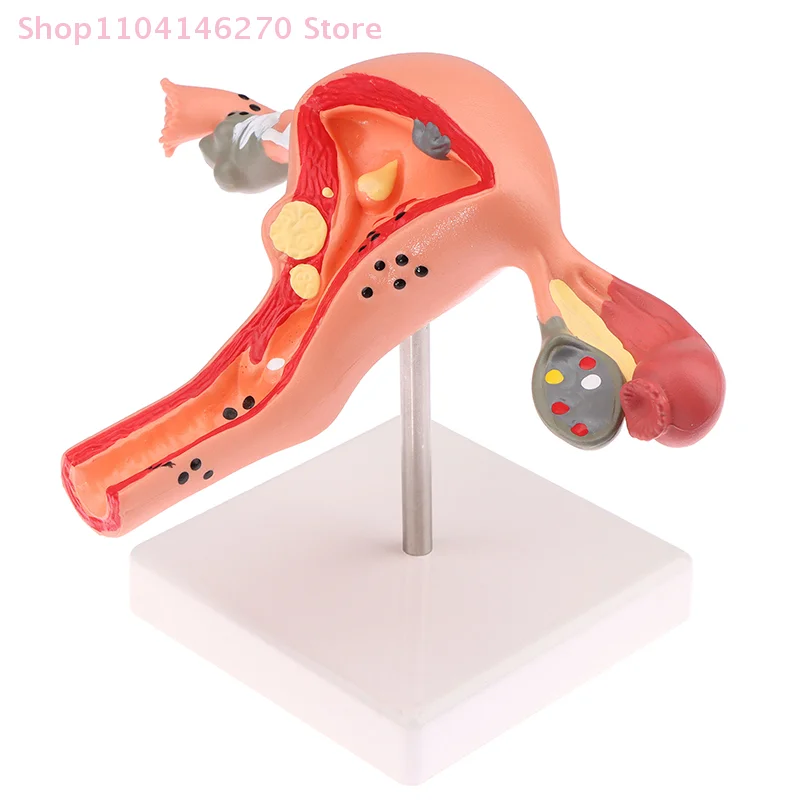 1Pcs Medical Props Model Pathological Uterus Ovary Anatomical Model Anatomy Cross Section Study Tool