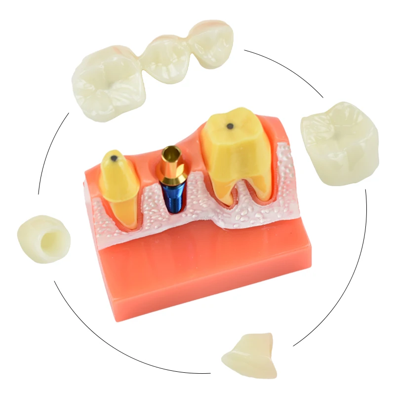 Dental Implant Teeth Model Analysis Crown Bridge 4 Times Implant Demonstration Removable Model Dentisty Lab