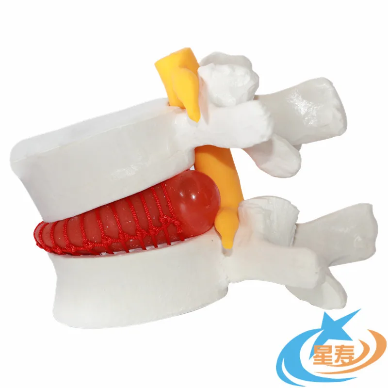 Demonstration model of lumbar disc herniation, lumbar model, intervertebral disc model, lesion lumbar model