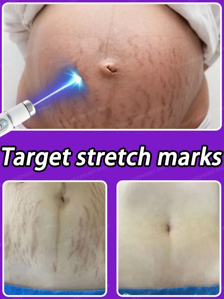 

Improve Stretch Marks