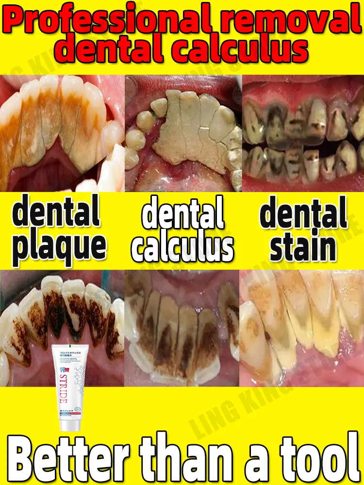 Dissolvant de calcul dentaire, blanchiment des dents, élimination des odeurs buccales, prévention de la mauvaise haleine, parodontite