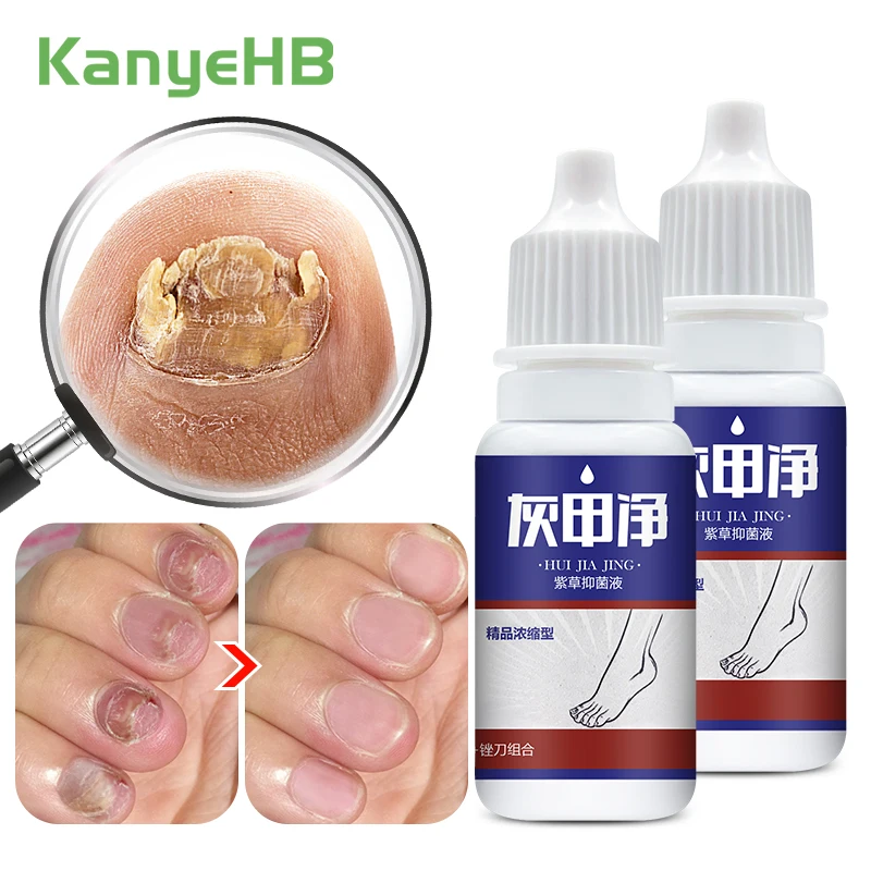 

2pcs Onychomycosis Nail Treatment Oil Hand Foot Nail Care Paronychia Nail Fungus Infection Toe Nail Anti-infective Essence A1133