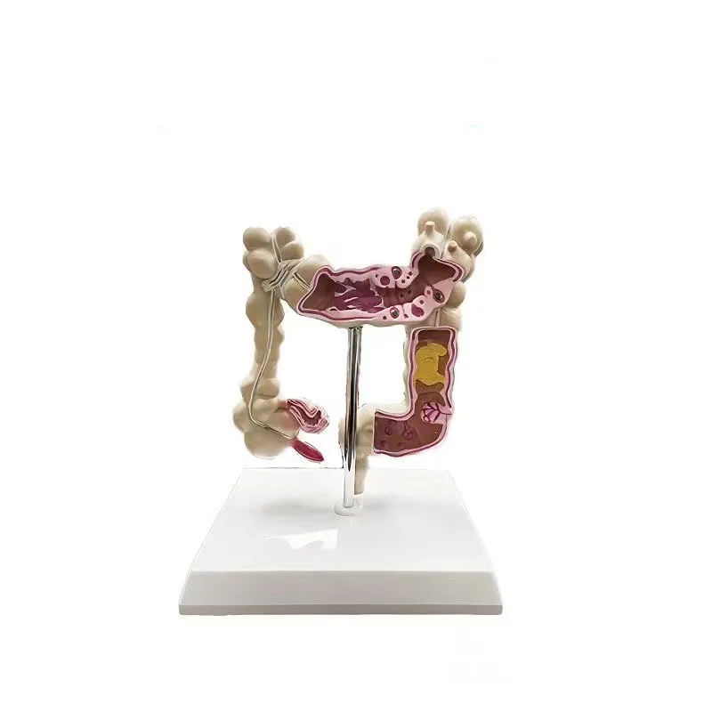 

Medical Science Colon Disease Model Colorectal Pathological Model Intestinal Pathology Human Organ Anatomy