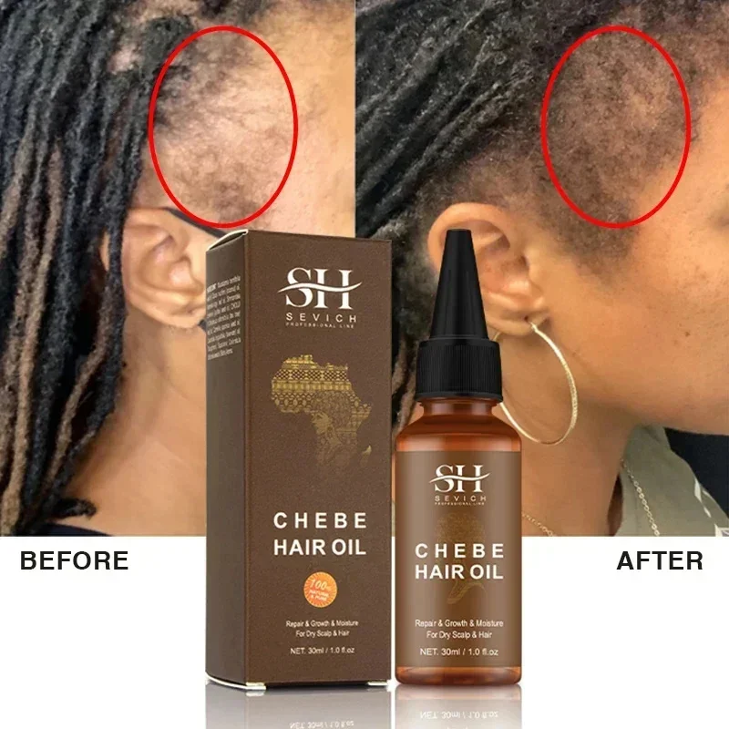 sevich-Africa-Oleo-de-crescimento-rapido-do-cabelo-oleo-chebe-produtos-de-tratamento-de-alopecia-por-tracao-reparar-danos-e-perda-anti-cabelo