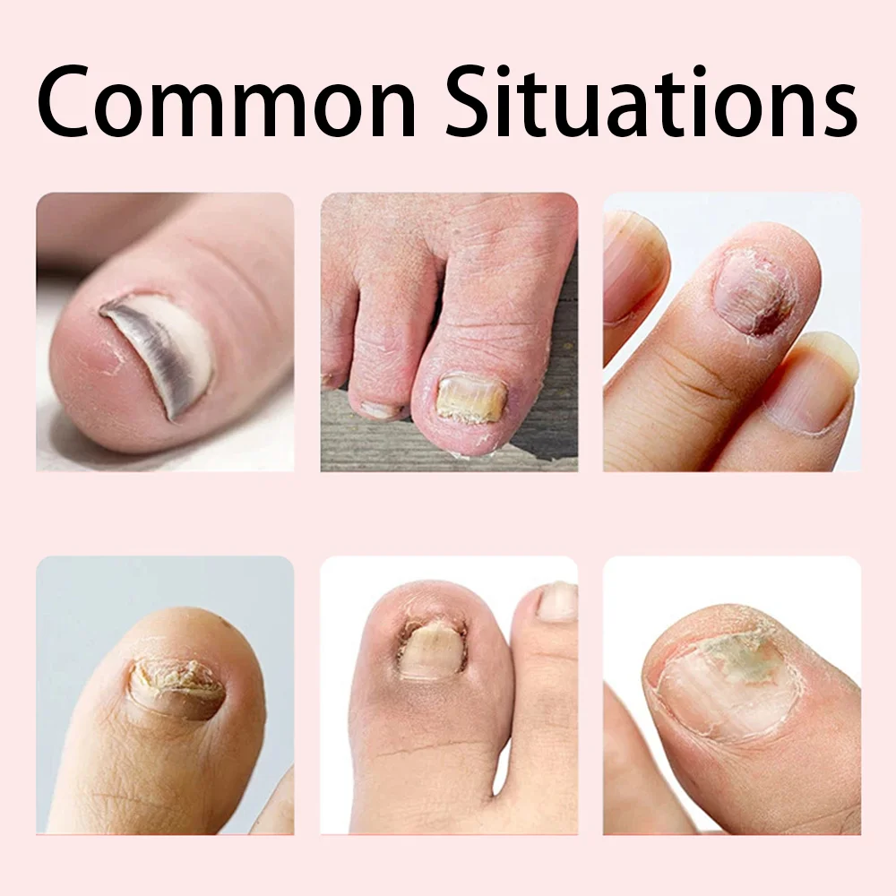 Zehennagel Nagel Pilz Behandlung Serum Fuß Reparatur Flüssigkeit Entfernung Ätherische Öle Fuß Nagel Pilz Reparatur Gel Hand Fuß Pflege