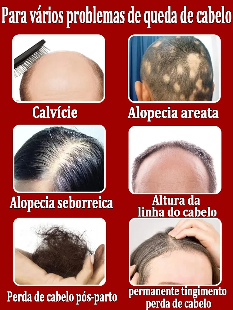 El aceite esencial para el crecimiento del cabello Angel Blue es el mejor regalo de Dios para las personas calvas, eliminando el problema de la