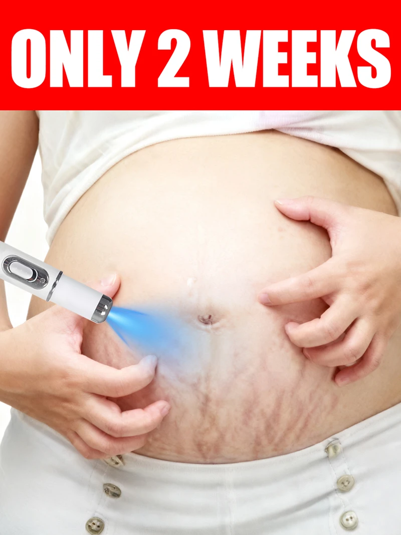 

from stretch marks on the body