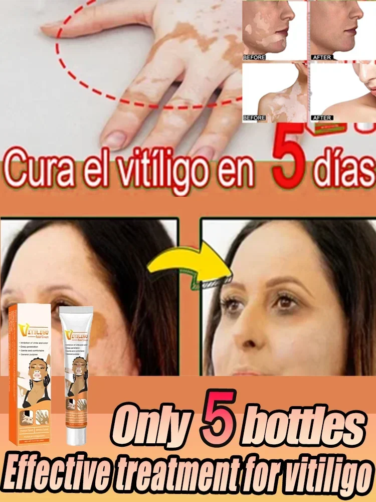 Cream For Vitiligo | Help Skin Pigmentation, Skin Colour Restoration Vitiligo