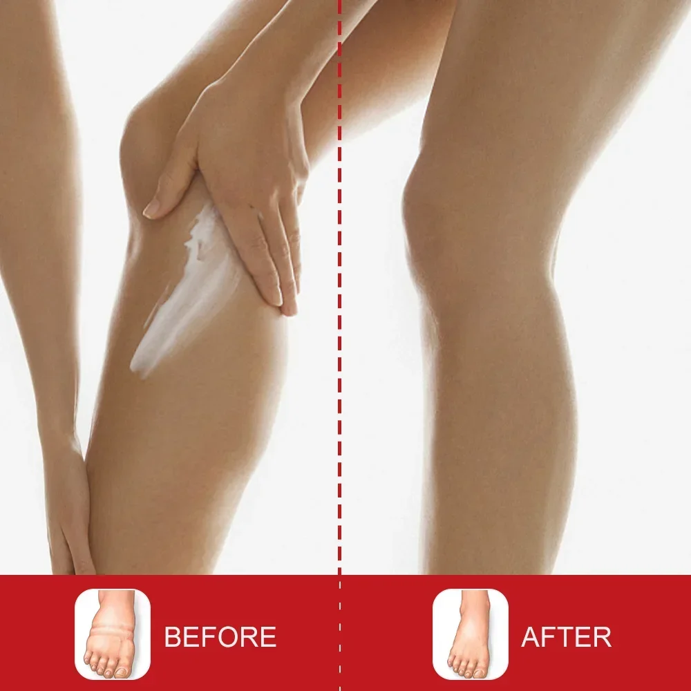 Leg Repair Pen Improving Blood Circulation Varicose Veins Relieves Leg Bulge Discomfort Cream Skin Body Health Care