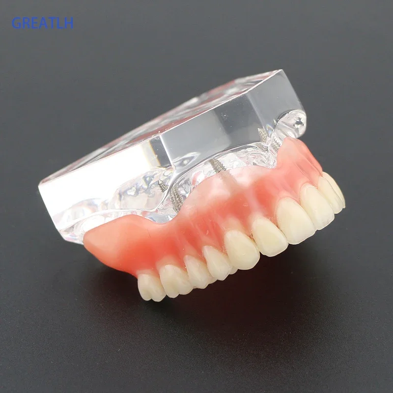 1pcs /pack Dental Upper Overdenture Superior 4 Implants Demo Model 6001 02 Teeth Model