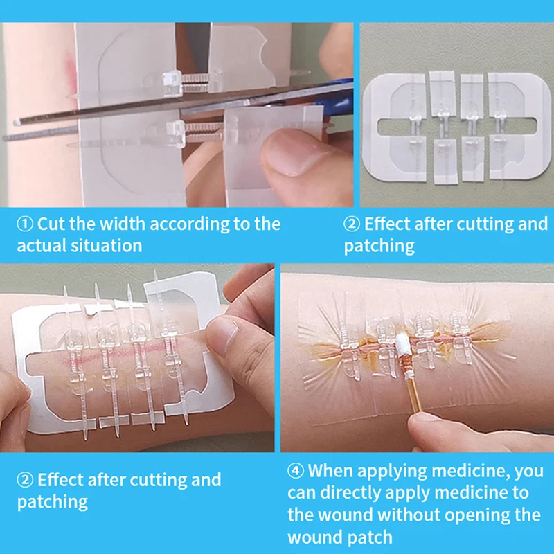 Band-Aid Zipper Tie Wound Closure Patch Hemostatic Patch Wound Fast Suture Zipper Band-Aid Outdoor