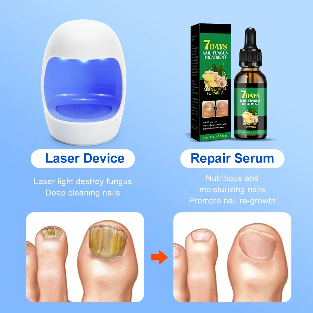 Dispositivo de tratamento do fungo do prego, Unhas do pé, Soro de reparação fúngica, Anti infecção, Unhas cinzentas, Onicomicose, Paroníquia Remover Ferramentas