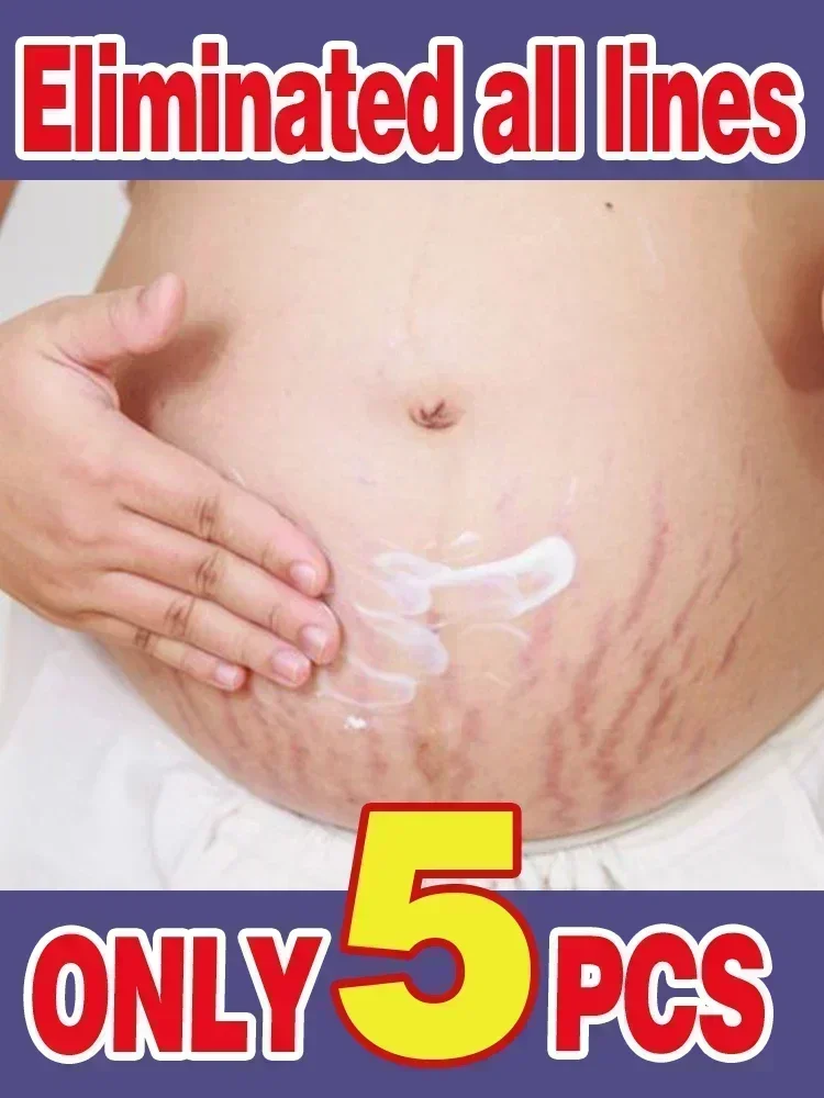 

Effective Stretch Marks Permanent Removal Cream Eliminate Body Belly Stretch Marks For Tunnels