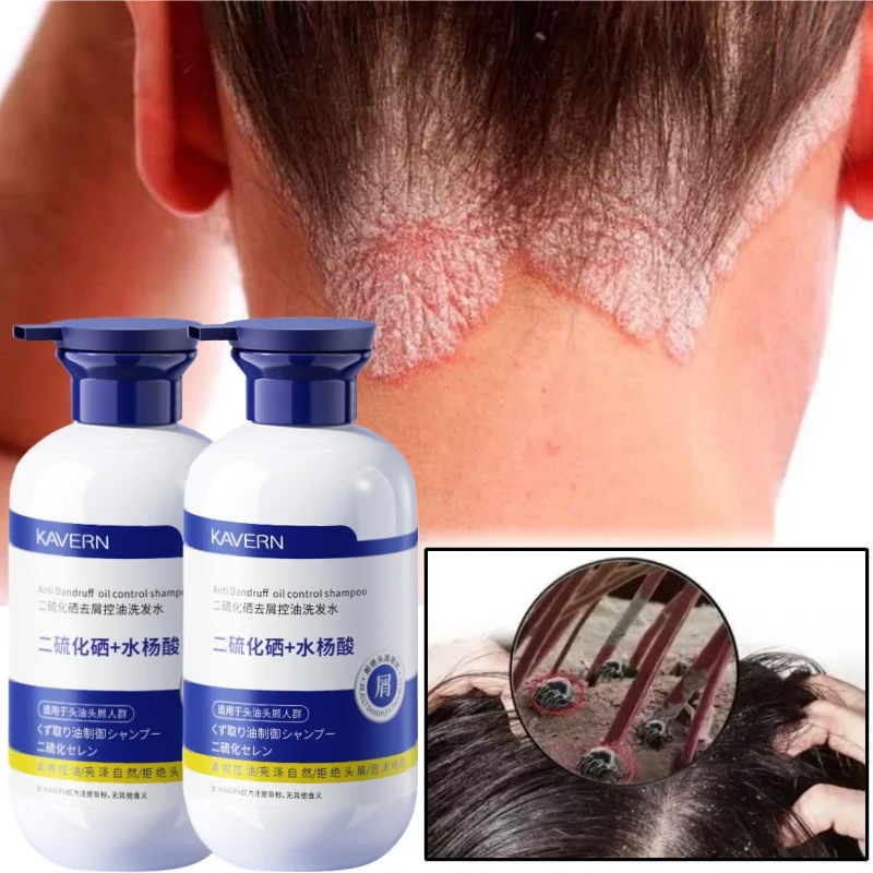 Selenium Disulfide Shampoo 500ml Oil-controlled Fluffy Anti-itchiness Scalp Hair Follicles Removal Mite Cleansing Shampoo