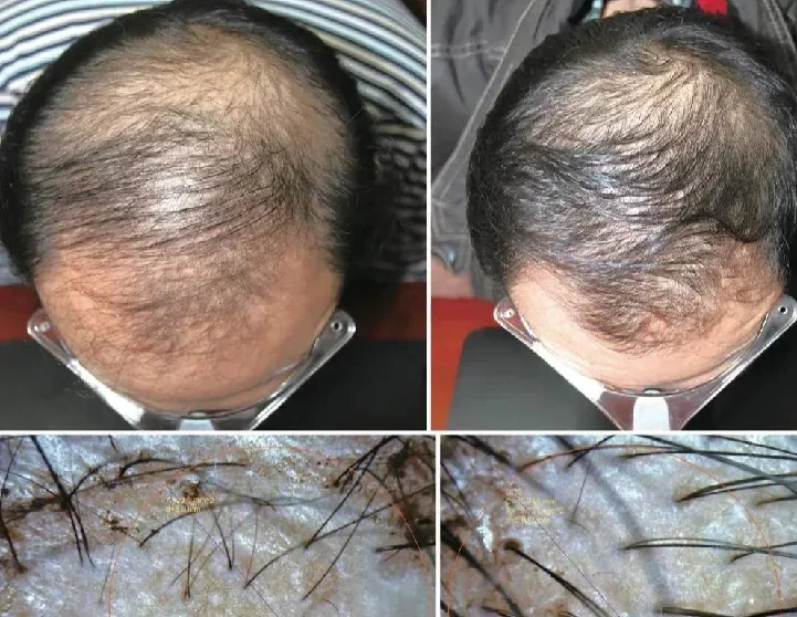 LLLT 650nm Low Level la ser Therapy Hair Loss Treatment Hair Follicle Regrowth la ser Cap Red Light Therapy Helmet