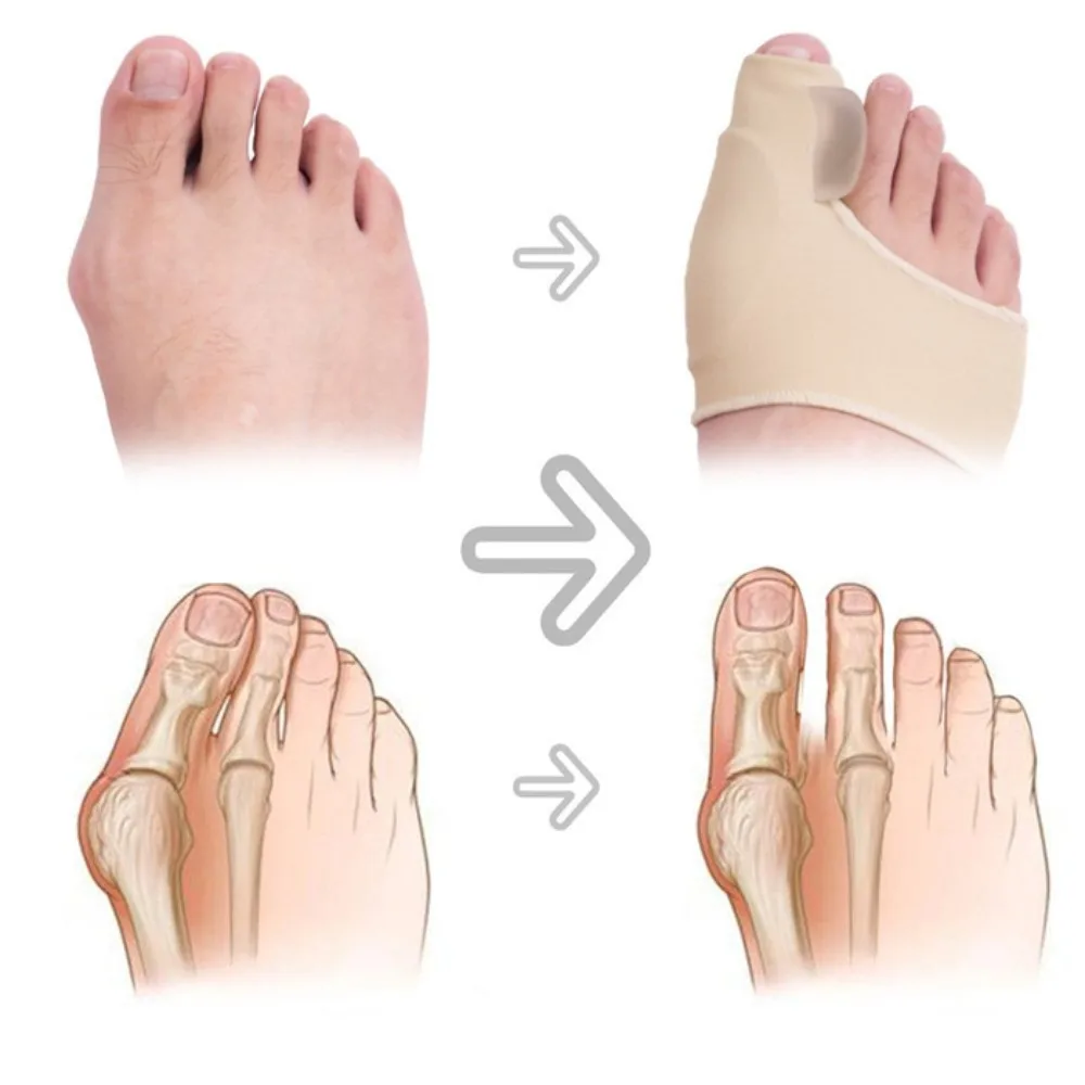 1Pcs Hallux Valgus Corrector Bunions For Toes Corrector Foot Finger Separator Toe Separator Foot Care Haluksy Bunion Corrector